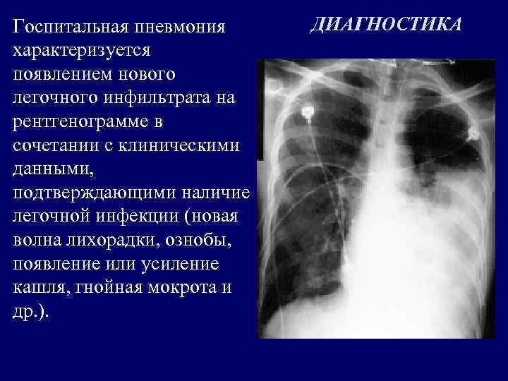 Госпитальная пневмония характеризуется появлением нового легочного инфильтрата на рентгенограмме в сочетании с клиническими данными,