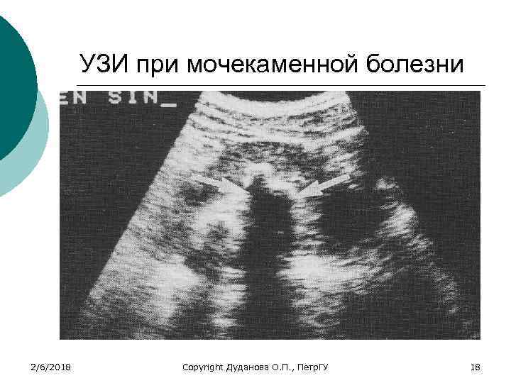 УЗИ при мочекаменной болезни 2/6/2018 Copyright Дуданова О. П. , Петр. ГУ 18 
