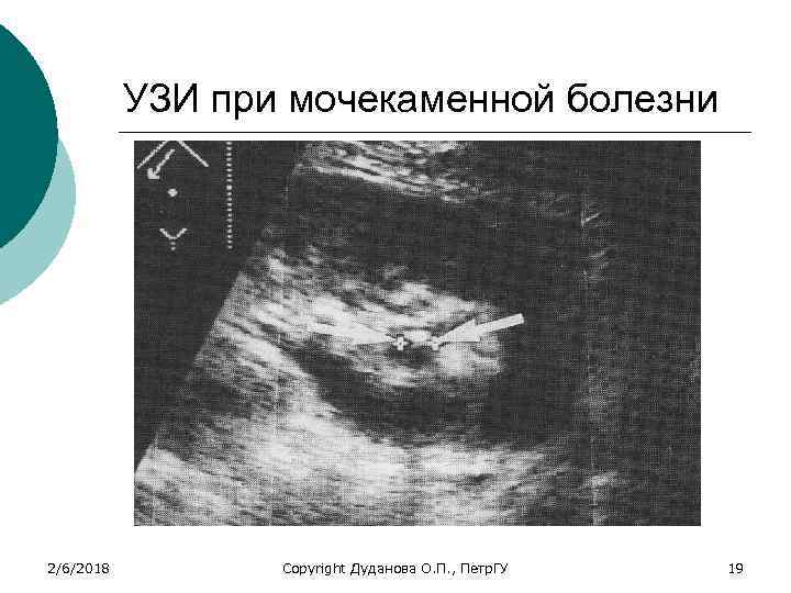 УЗИ при мочекаменной болезни 2/6/2018 Copyright Дуданова О. П. , Петр. ГУ 19 
