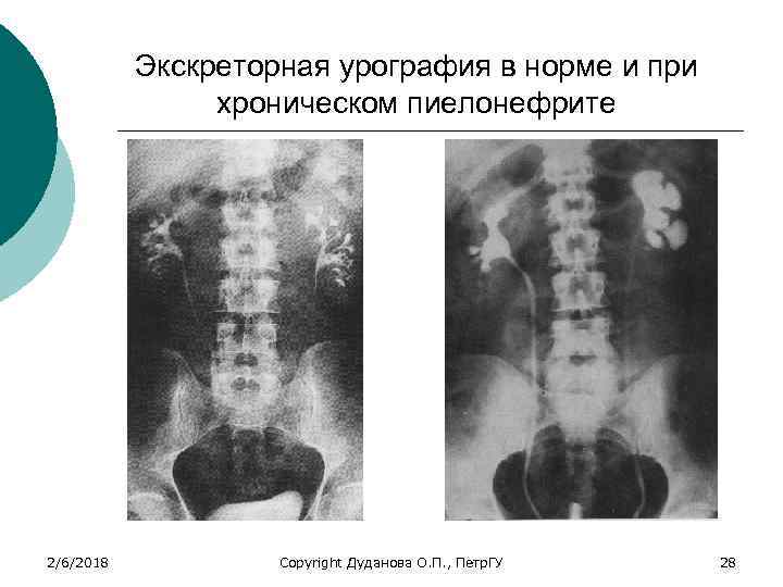 Экскреторная урография в норме и при хроническом пиелонефрите 2/6/2018 Copyright Дуданова О. П. ,