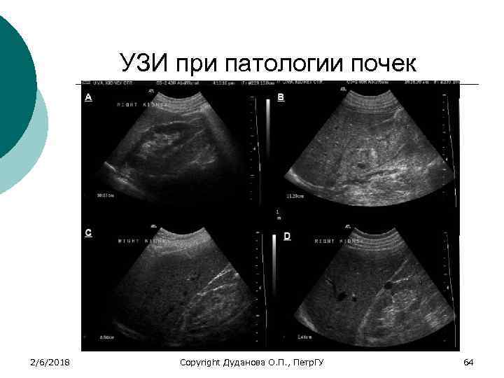 УЗИ при патологии почек 2/6/2018 Copyright Дуданова О. П. , Петр. ГУ 64 
