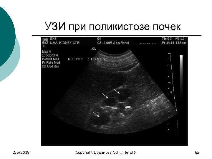 УЗИ при поликистозе почек 2/6/2018 Copyright Дуданова О. П. , Петр. ГУ 65 
