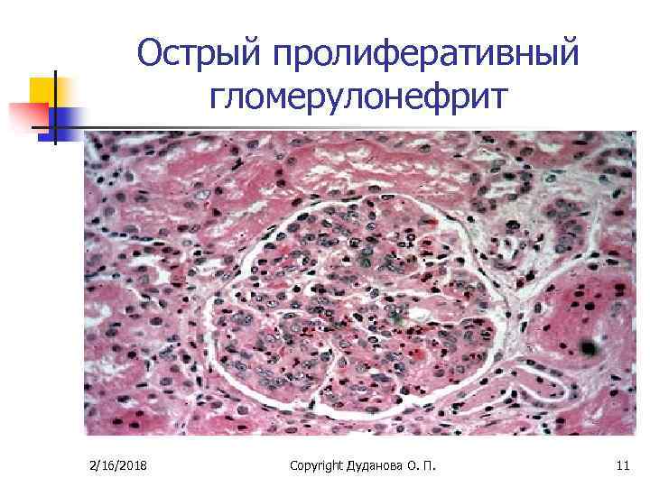 Острый гломерулонефрит микроскопическая картина