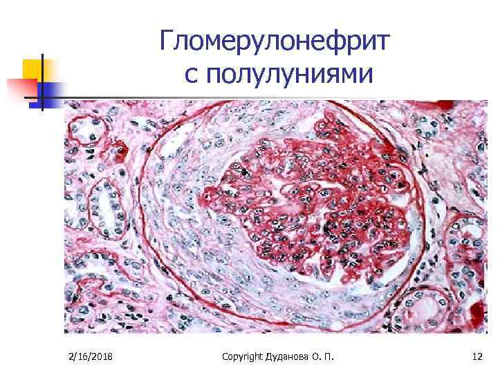 Острый гломерулонефрит картинки