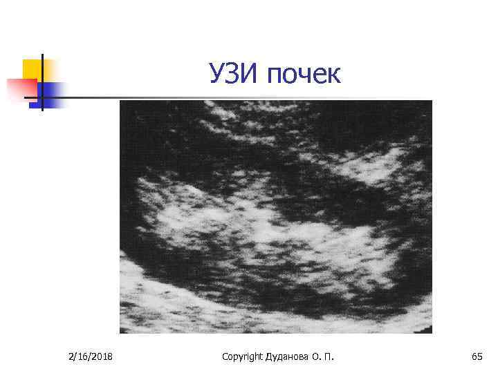 Гломерулонефрит узи картина