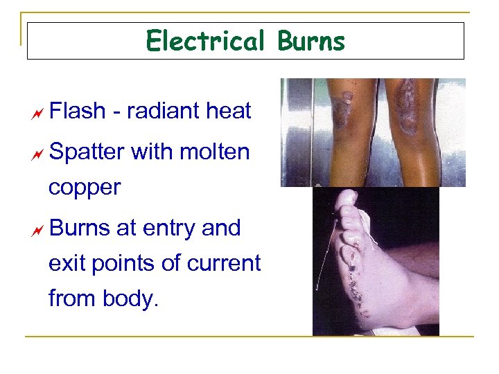 Electrical Burns ~ Flash - radiant heat ~ Spatter with molten copper ~ Burns