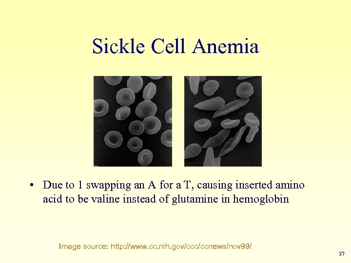 Sickle Cell Anemia • Due to 1 swapping an A for a T, causing