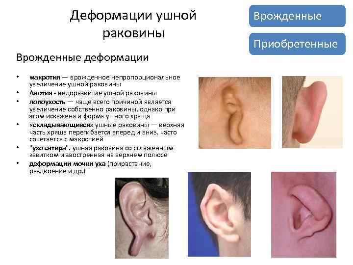 Деформации ушной раковины Врожденные деформации • • • макротия — врожденное непропорциональное увеличение ушной