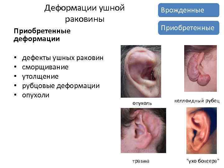Деформации ушной раковины Врожденные Приобретенные деформации • • • дефекты ушных раковин сморщивание утолщение