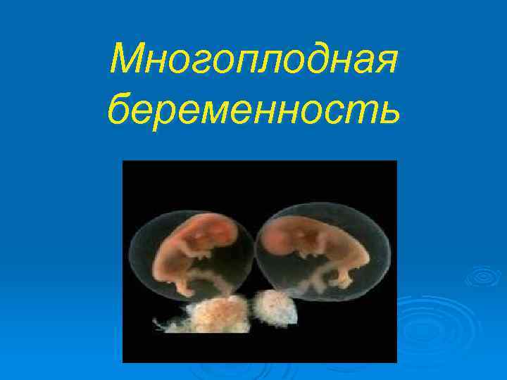 Многоплодная беременность. Многоплодная беременность презентация. Многоплодие презентация. Многоплодная беременность пре.