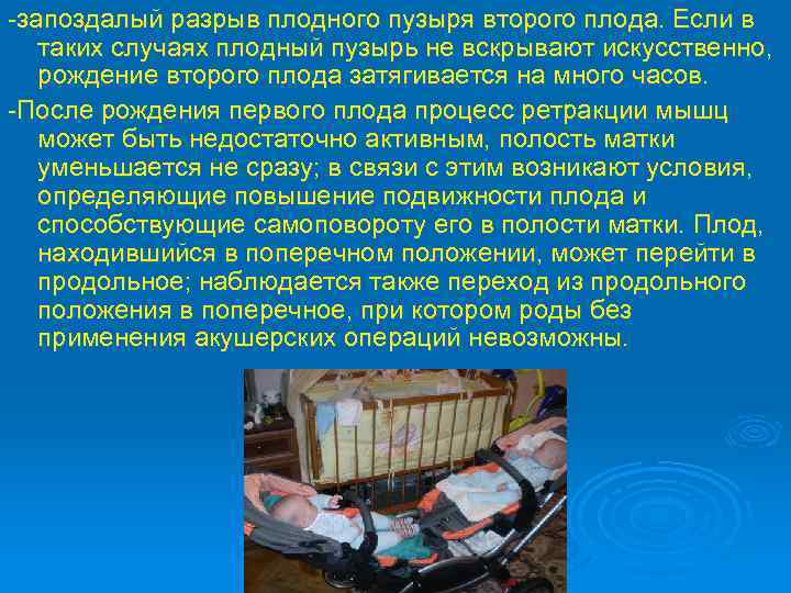 -запоздалый разрыв плодного пузыря второго плода. Если в таких случаях плодный пузырь не вскрывают