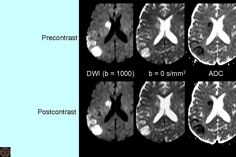 Precontrast DWI (b = 1000) 　 b = 0 s/mm 2 Postcontrast 　　ADC Can