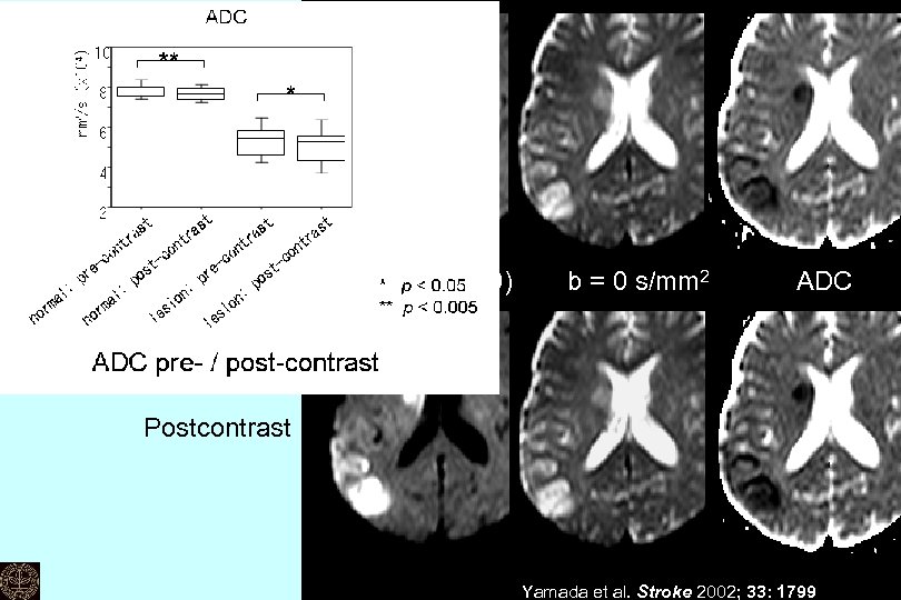 Precontrast DWI (b = 1000) 　 b = 0 s/mm 2 　　ADC Postcontrast Kei
