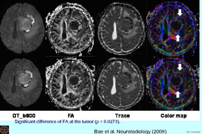 Significant difference of FA at the tumor (p = 0. 0273). Bae et al.