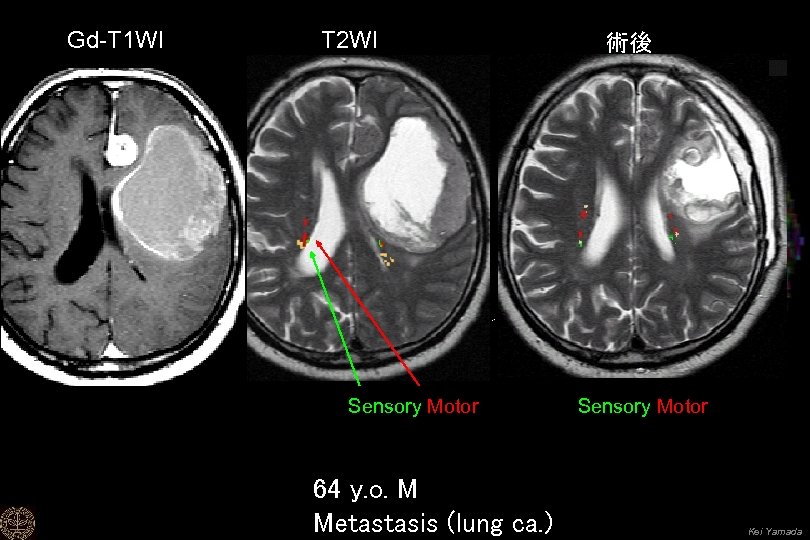 Gd-T 1 WI T 2 WI Sensory Motor 64 y. o. M Metastasis (lung