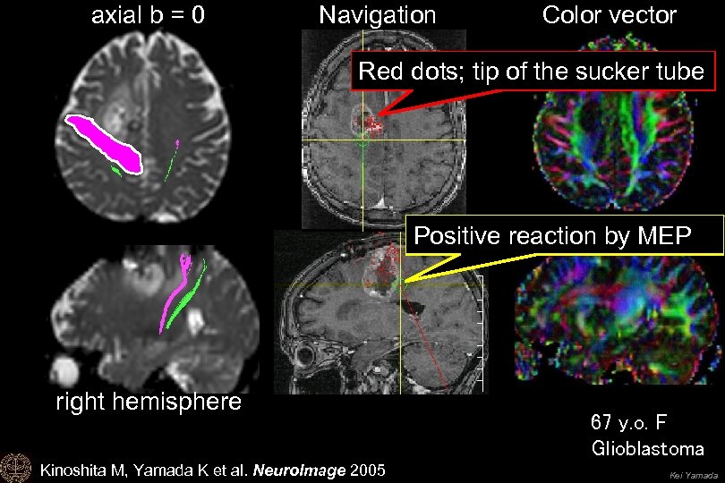 axial b = 0 Navigation Color vector Red dots; tip of the sucker tube