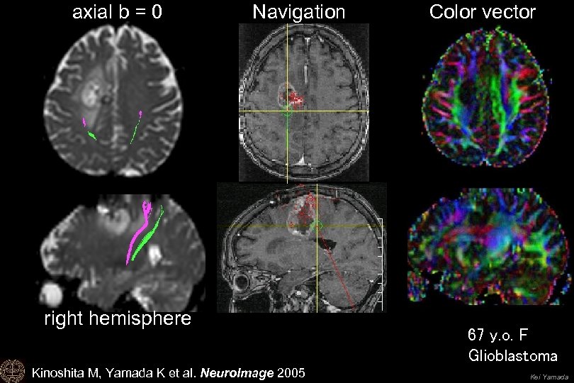 axial b = 0 Navigation right hemisphere Kinoshita M, Yamada K et al. Neuro.