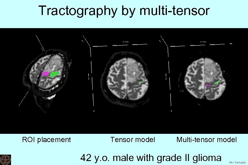 Tractography by multi-tensor ROI placement Tensor model Multi-tensor model 42 y. o. male with
