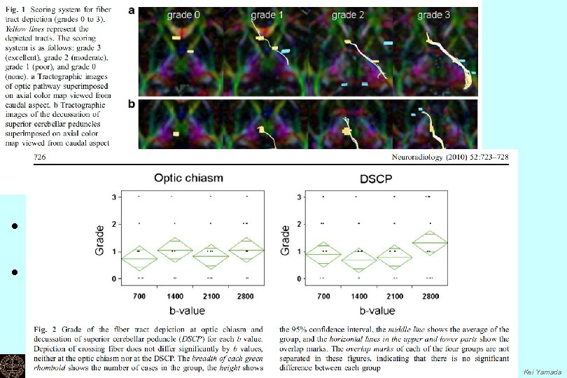  • Visual grading of the crossing fibers • Two locations; Ø optic chiasm