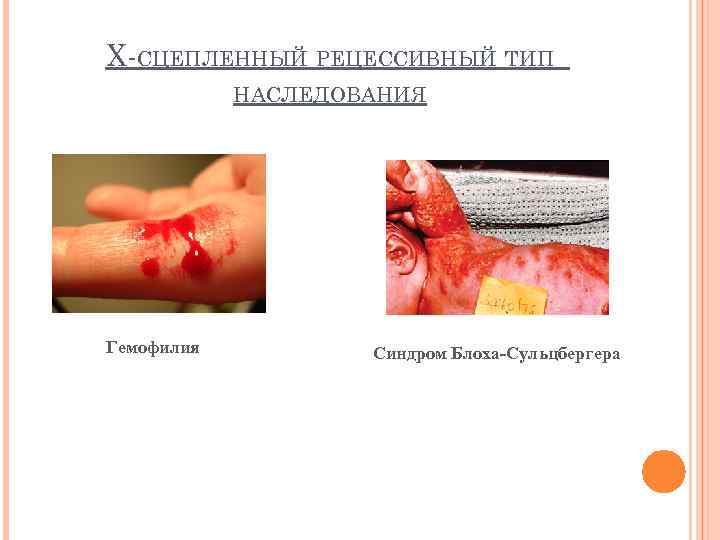 Х-СЦЕПЛЕННЫЙ РЕЦЕССИВНЫЙ ТИП НАСЛЕДОВАНИЯ Гемофилия Синдром Блоха-Сульцбергера 