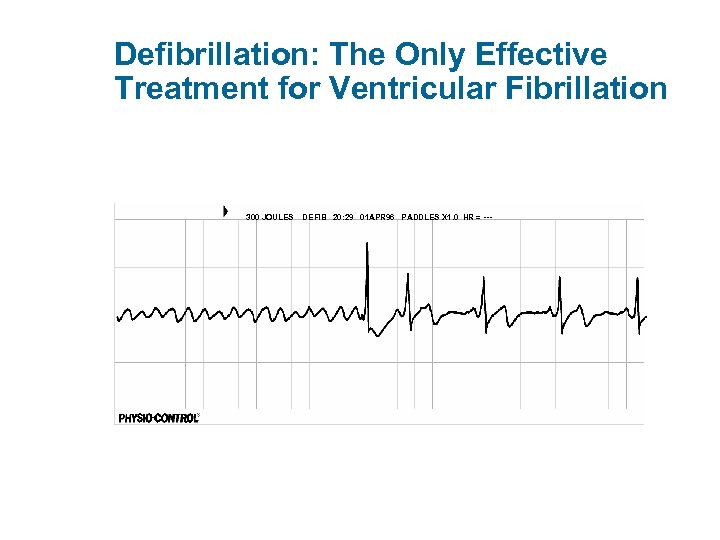 Defibrillation: The Only Effective Treatment for Ventricular Fibrillation 300 JOULES DEFIB 20: 29 01