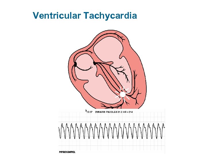 Ventricular Tachycardia 12: 57 29 MAR 96 PADDLES X 1. 0 HR = 214