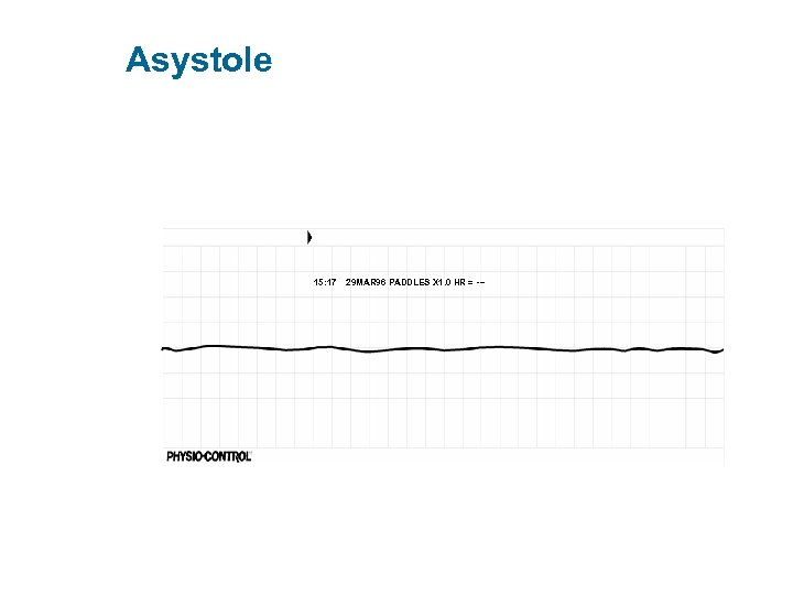 Asystole 15: 17 29 MAR 96 PADDLES X 1. 0 HR = --- 