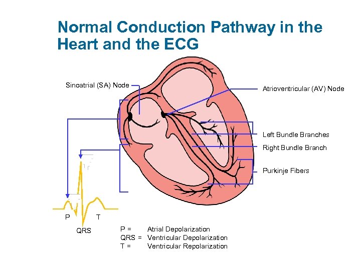 Normal Conduction Pathway in the Heart and the ECG Sinoatrial (SA) Node Atrioventricular (AV)