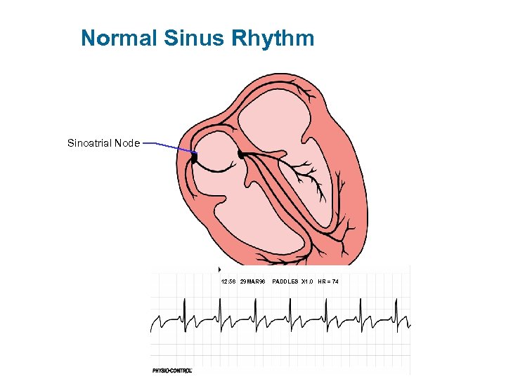 Normal Sinus Rhythm Sinoatrial Node 12: 56 29 MAR 96 PADDLES X 1. 0