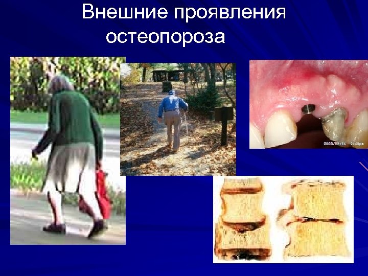 Внешние проявления остеопороза 