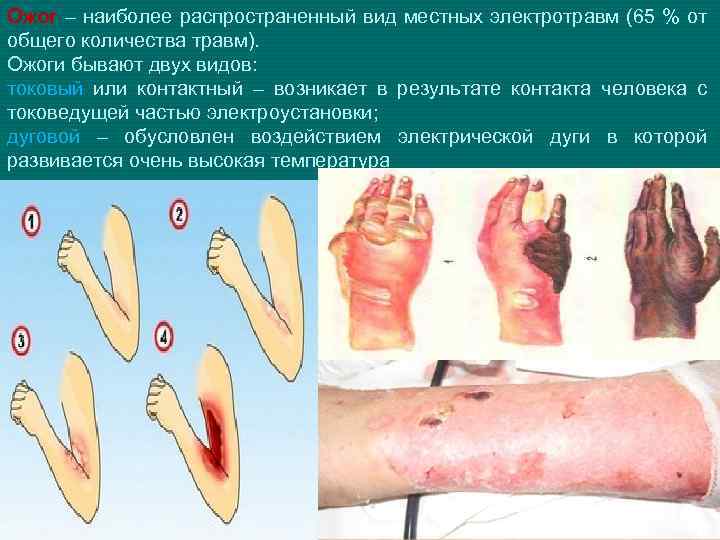 Ожог – наиболее распространенный вид местных электротравм (65 % от общего количества травм). Ожоги