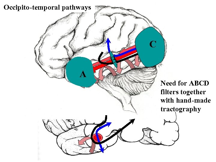 Occipito-temporal pathways C B A Need for ABCD filters together with hand-made tractography 