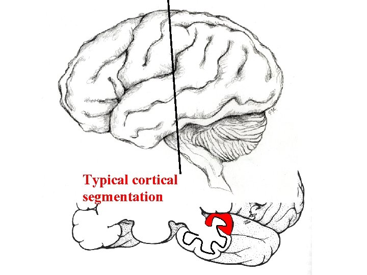 Typical cortical segmentation 