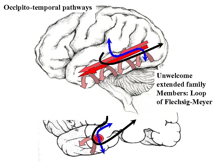 Occipito-temporal pathways Unwelcome extended family Members: Loop of Flechsig-Meyer 