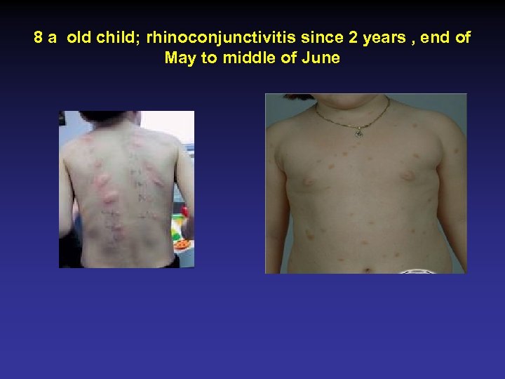 8 a old child; rhinoconjunctivitis since 2 years , end of May to middle