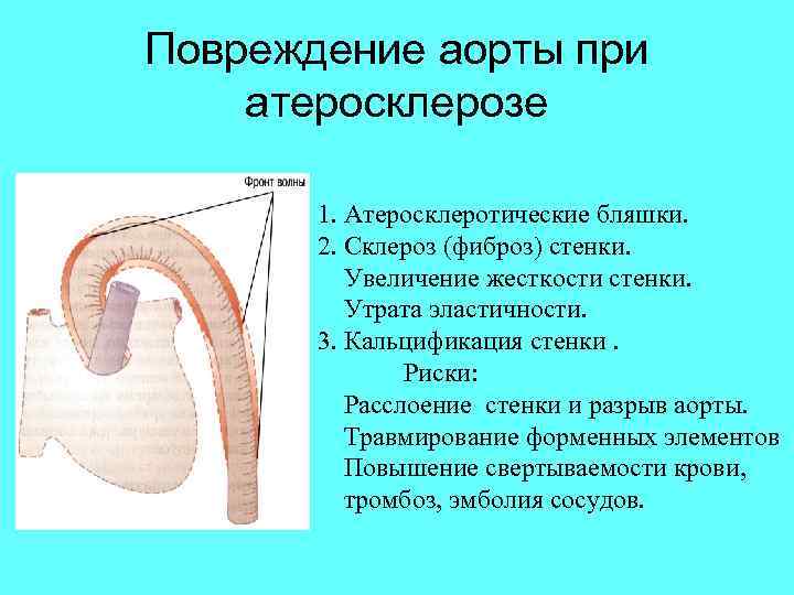 Повреждение аорты при атеросклерозе 1. Атеросклеротические бляшки. 2. Склероз (фиброз) стенки. Увеличение жесткости стенки.