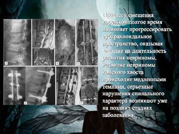 Процессу смещения корешков долгое время позволяет прогрессировать субарахноидальное пространство, оказывая влияние на длительность развития