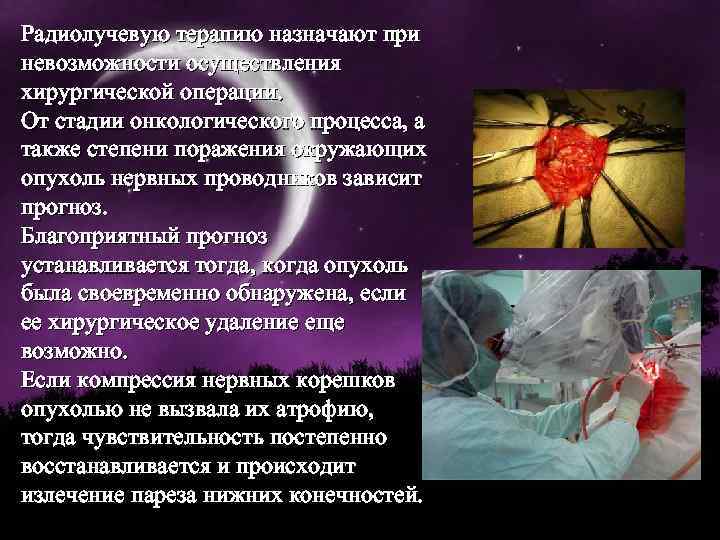 Радиолучевую терапию назначают при невозможности осуществления хирургической операции. От стадии онкологического процесса, а также