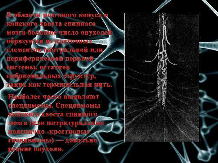 В области мозгового конуса и конского хвоста спинного мозга большое число опухолей образуется из