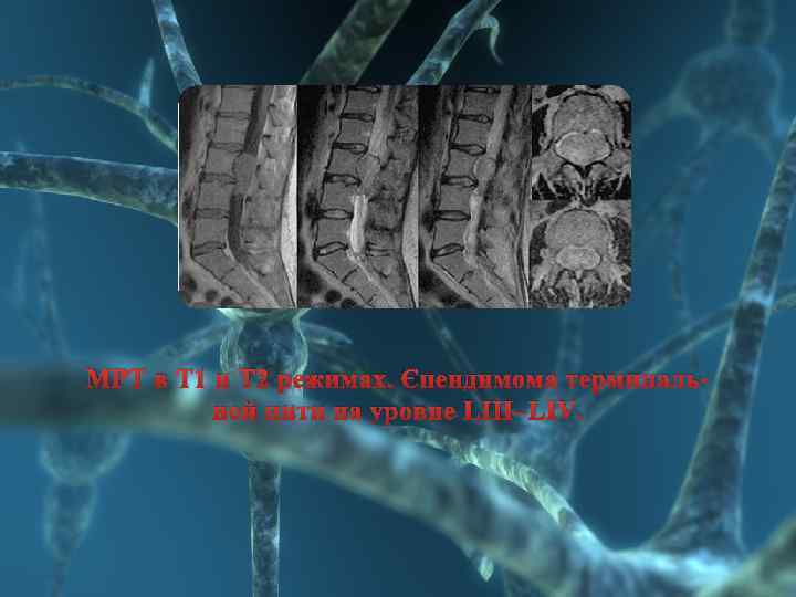 МРТ в Т 1 и Т 2 режимах. Эпендимома терминальной нити на уровне LIII–LIV.