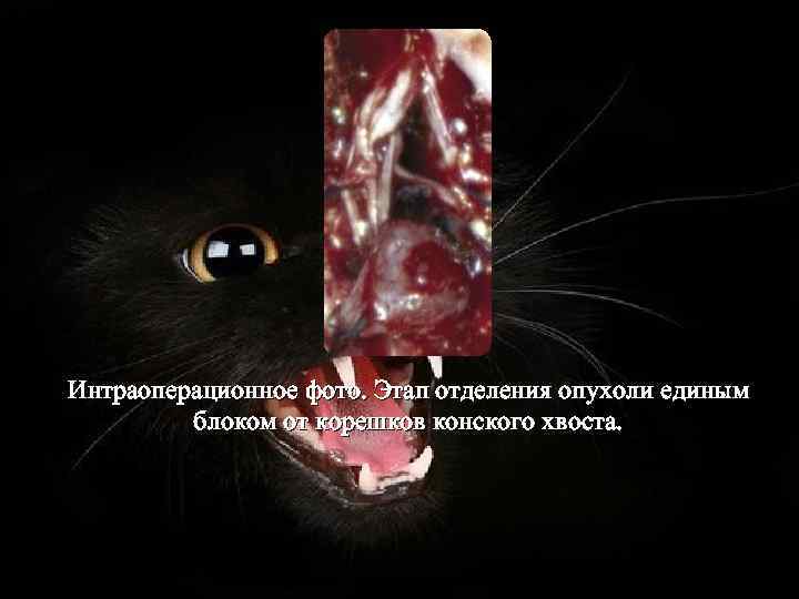 Интраоперационное фото. Этап отделения опухоли единым блоком от корешков конского хвоста. 