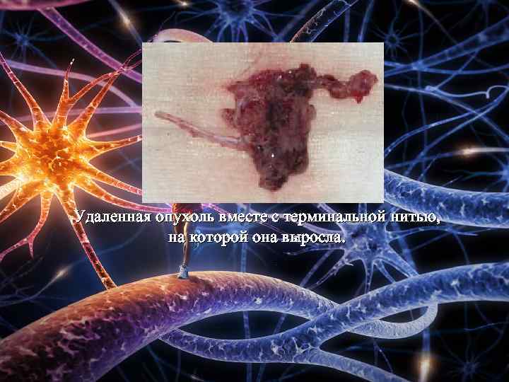 Удаленная опухоль вместе с терминальной нитью, на которой она выросла. 