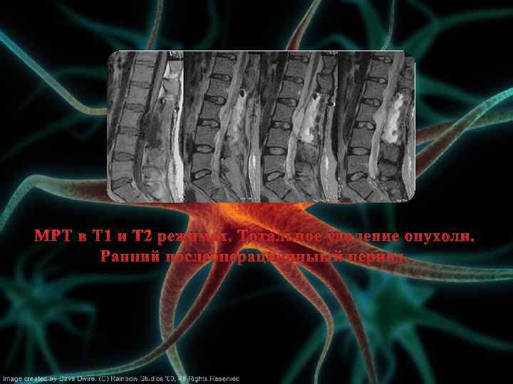 МРТ в Т 1 и Т 2 режимах. Тотальное удаление опухоли. Ранний послеоперационныый период.