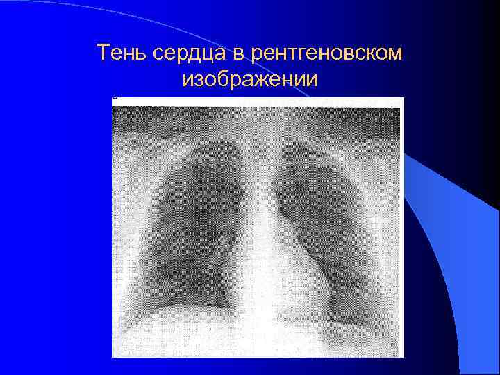 Тень сердца в рентгеновском изображении 
