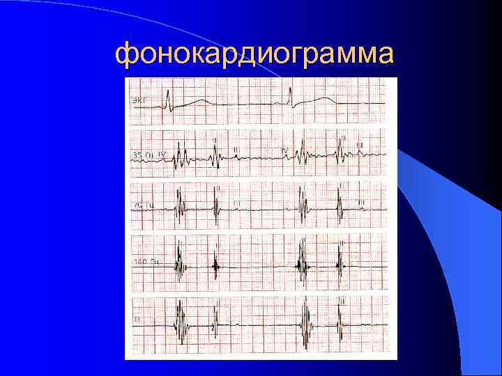 фонокардиограмма 