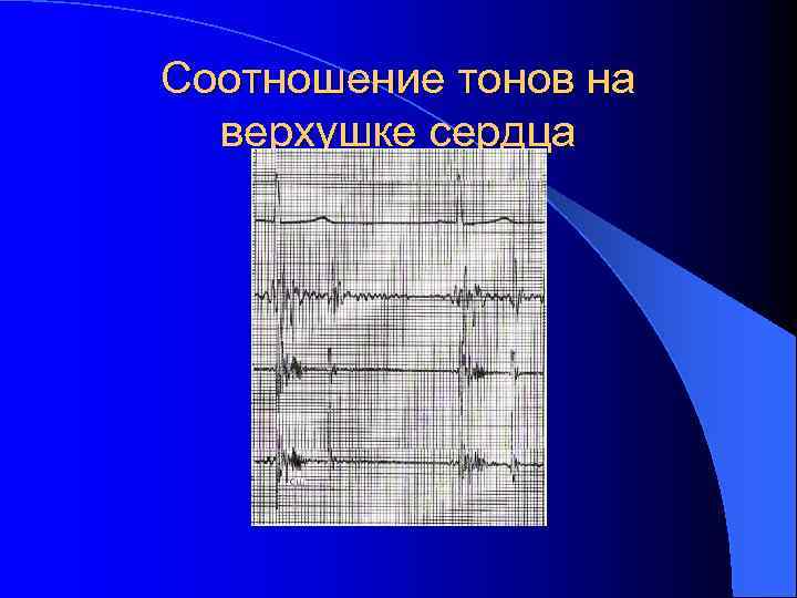 Соотношение тонов на верхушке сердца 
