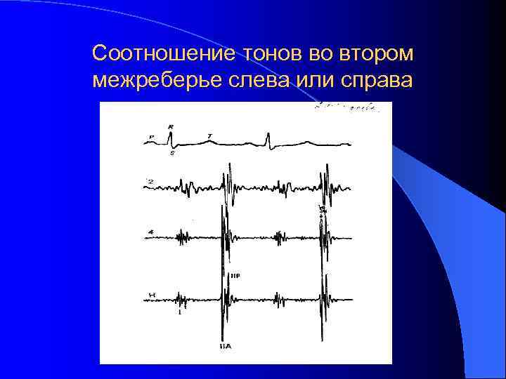 Соотношение тонов во втором межреберье слева или справа 