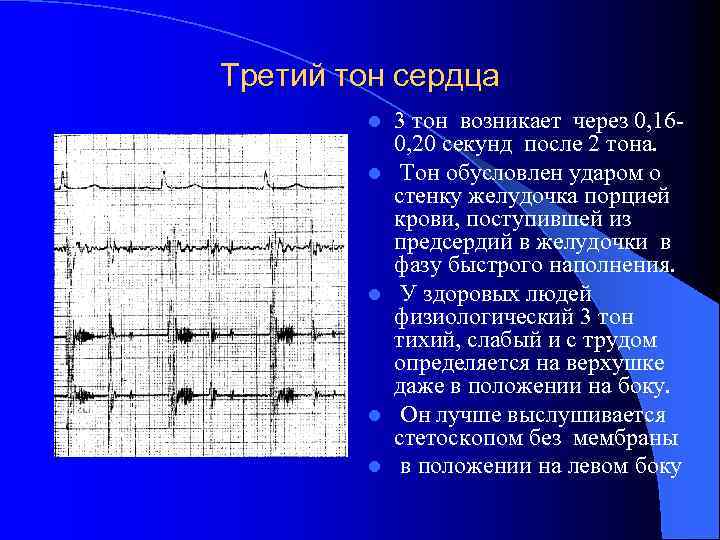 Третий тон сердца l l l 3 тон возникает через 0, 160, 20 секунд