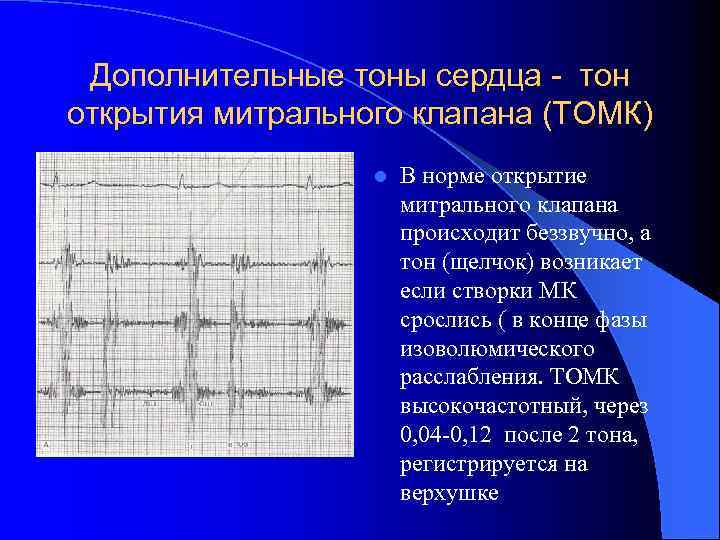 Дополнительные тоны сердца - тон открытия митрального клапана (ТОМК) l В норме открытие митрального