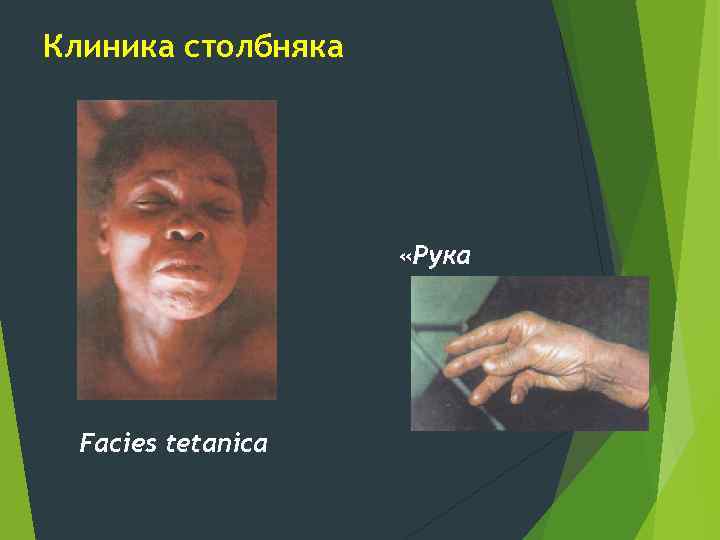 Клиника столбняка акушера» Facies tetanica «Рука 